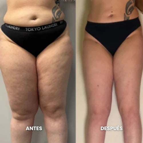 Comparación antes y después de muslos facilitada para la reseña 3