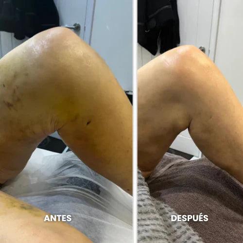 Comparación antes y después de piernas con venas visibles facilitada para la reseña 2
